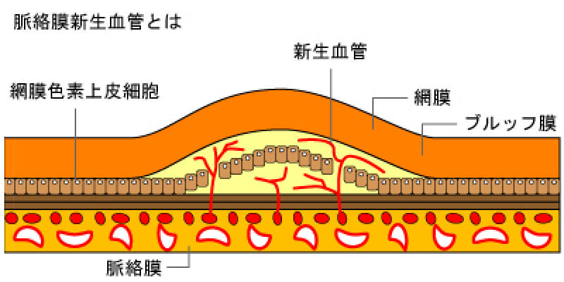 図「脈絡膜新生血管とは」