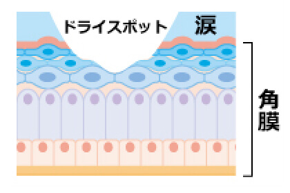 図「ドライアイの目」