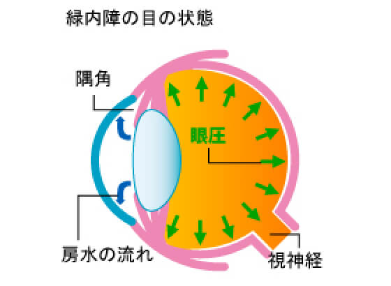 緑内障患者の目の状態