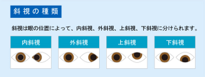 斜視の種類